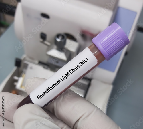 Blood sample for Neurofilament Light Chain(NfL), Plasma test, to diagnosis of Alzheimer's disease. Amyloid-Tau-Neurodegeneration (ATN) Profile. photo