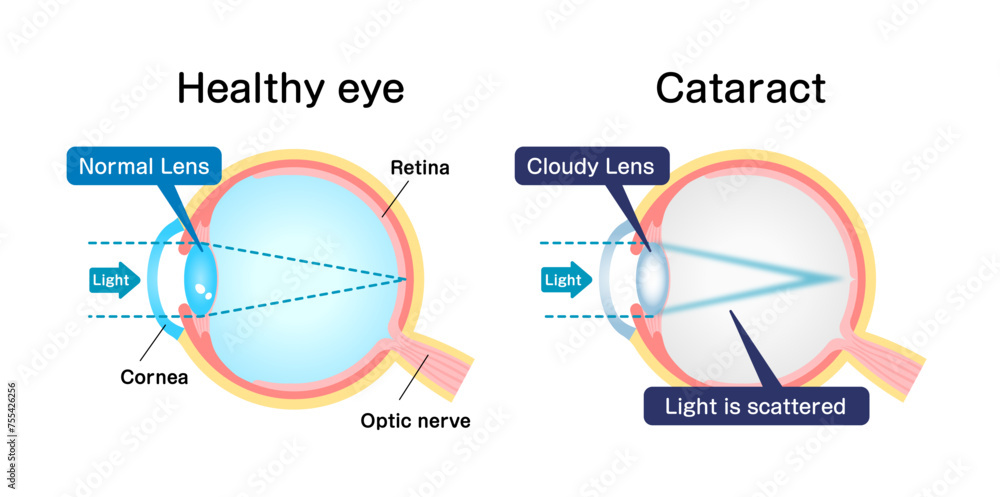 Causes and mechanism of cataract vector illustration Causes and mechanism of cataract vector illustration