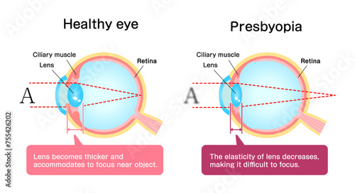 Causes and mechanism of cataract vector illustration photo