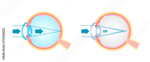 Causes and mechanism of cataract vector illustration