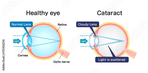 Causes and mechanism of cataract vector illustration photo