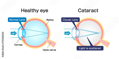Causes and mechanism of cataract vector illustration
