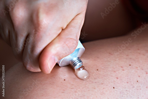 A man squeezes an anti-inflammatory gel treatment cream from a tube onto his leg. Treatment of arthrosis and arthritis, anti-inflammatory ointment for the treatment of joints, close-up, medicine