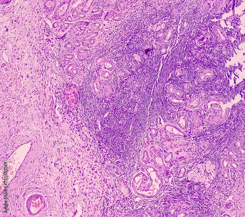 Photo of benign brenner tumor of ovary, showing tumor sheet on the right side and ovarian stroma on the right side. photo