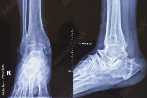 X-ray of ankle joint both view. Diffuse sclerosis at tarsal, metatarsal bones and distal shaft of tibia and fibula with deformed shaped. joint spaces are markedly reduced. photo