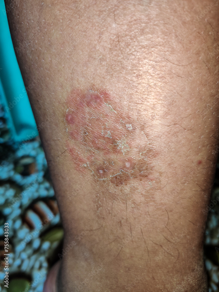 Fototapeta premium Close up of ringworm on the thigh of Asian man