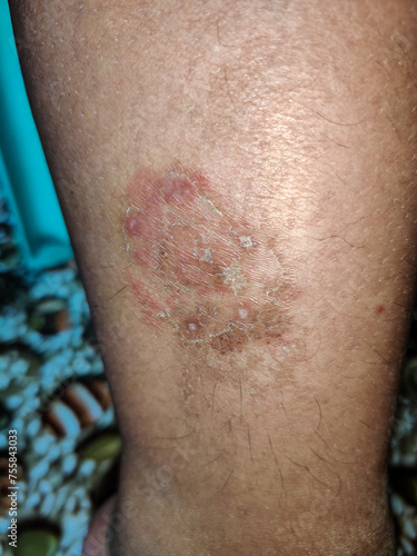 Close up of ringworm on the thigh of Asian man photo