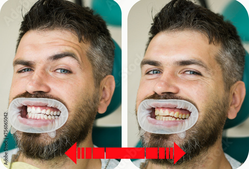 Teeth yellow vs white, before or after whitening. Man with isolated background touching mouth with painful expression because of toothache or dental illness on teeth. Close-up detail of man teeth