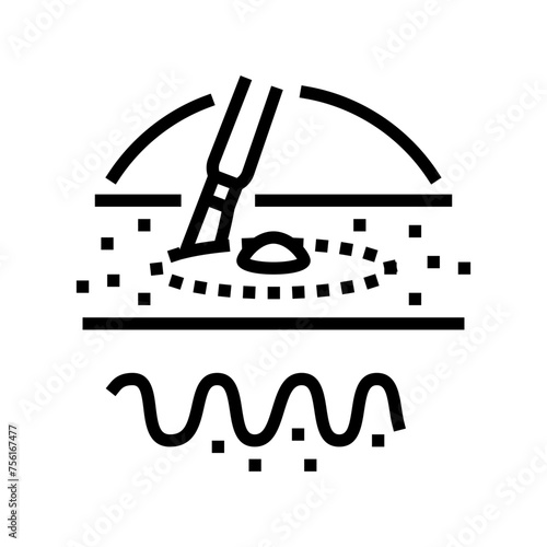 excisional biopsy surgery line icon vector. excisional biopsy surgery sign. isolated contour symbol black illustration