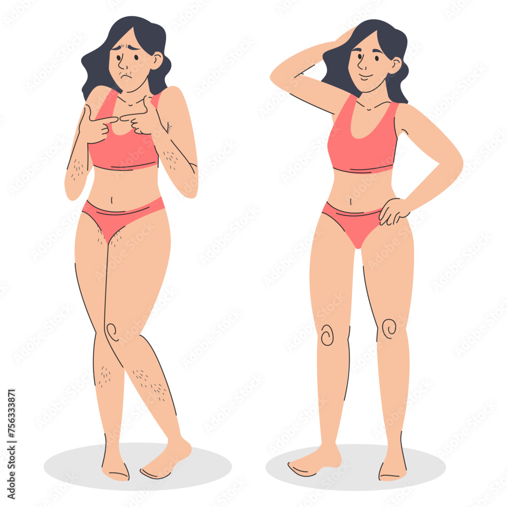 Woman before and after hair removal vector isolated. Illustration of a female person in swimwear with hair all over the body and without hair after laser depilation. Epilation procedure advertising. Woman before and after hair removal vector isolated. Illustration of a female person in swimwear with hair all over the body and without hair after laser depilation. Epilation procedure advertising.