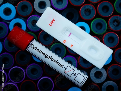 Blood sample of patient negative tested for cytomegalovirus by rapid diagnostic test. photo