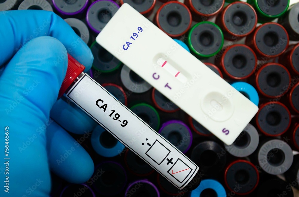 Fototapeta premium Blood sample of patient positive tested for CA 19-9 by rapid diagnostic test.