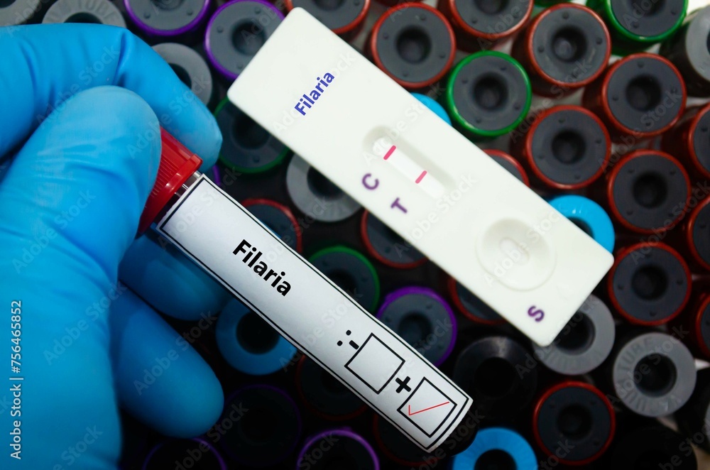Fototapeta premium Blood sample of patient positive tested for filaria by rapid diagnostic test.