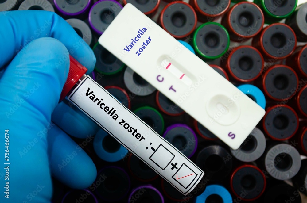 Fototapeta premium Blood sample of patient positive tested for varicella zoster by rapid diagnostic test.
