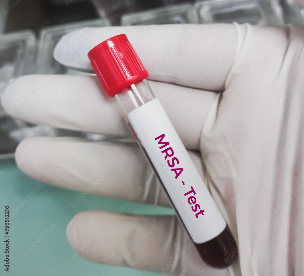Blood sample for MRSA screening test. Bacterial infection that is