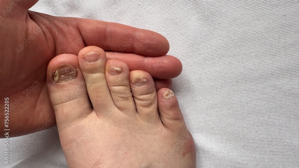 Toenail fungus of unhealthy person. Nails affected by a fungal infection. Onycholysis of nails. Close-up. Toenail fungus of unhealthy person. Nails affected by a fungal infection. Onycholysis of nails. Close-up.