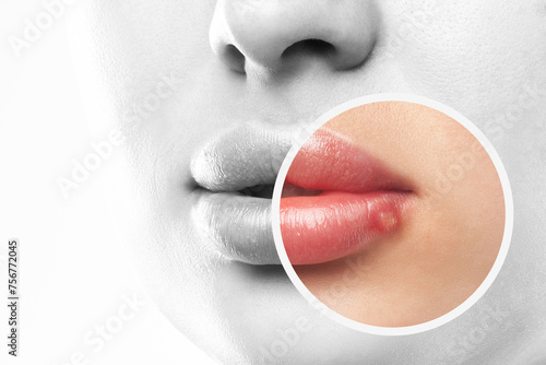 Fotografía Woman showing herpes disease on her lips
