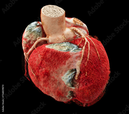 Canvas Print CTA Coronary artery  3D rendering image showing coronary tree and heart 3D