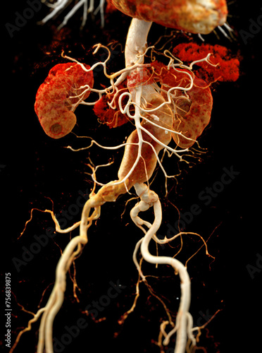 CTA abdominal aorta showing abdomenal aortic dissection 3D rendering. photo