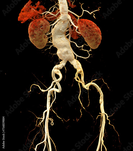 CTA abdominal aorta showing abdomenal aortic dissection 3D rendering. photo