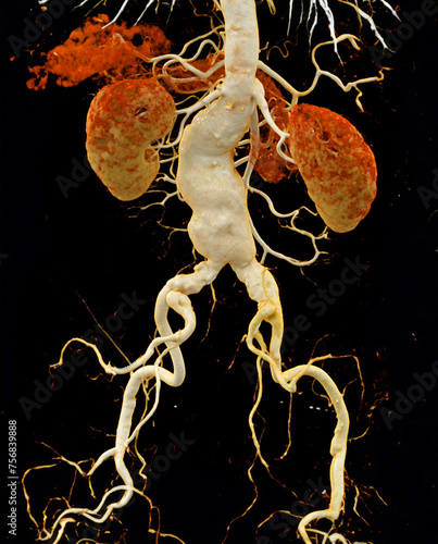 CTA abdominal aorta showing abdomenal aortic dissection 3D rendering. photo