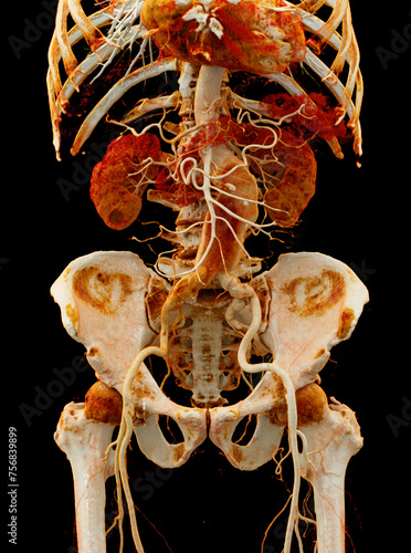 CTA abdominal aorta showing abdomenal aortic dissection 3D rendering. photo