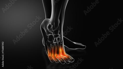 Metatarsalgia or Ball of Foot Pain photo