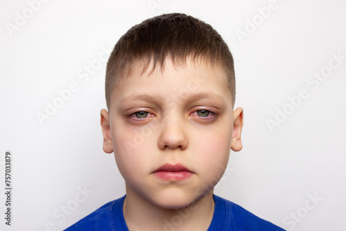 Close-up portrait of a child with red puffy eyes, isolated on a white background. Unhealthy appearance. Irritation and itching of the eyes caused by conjunctivitis, inflammation, infection. Allergy
 photo