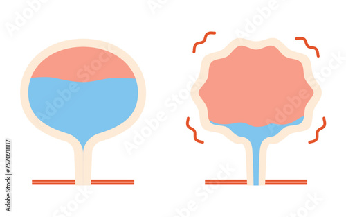 過活動膀胱の医療イラスト、正常な膀胱と過活動膀胱の比較