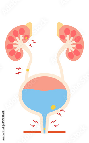 尿路結石の医療イラスト、腎結石・尿管結石・膀胱結石・尿道結石