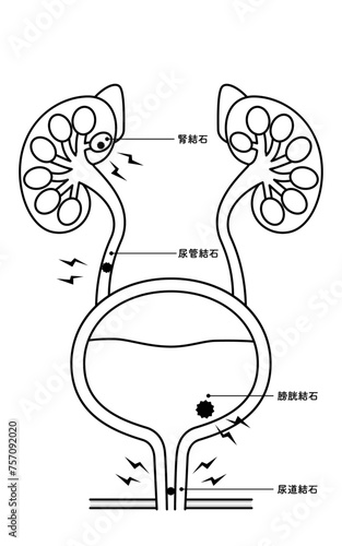 尿路結石の医療イラスト、腎結石・尿管結石・膀胱結石・尿道結石