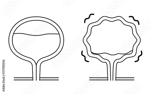 Medical illustration of overactive bladder, normal bladder vs.