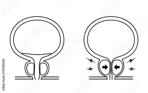 Medical illustration of benign prostatic hyperplasia, normal vs. enlarged prostate