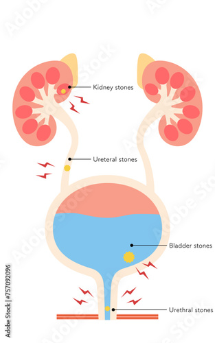 Medical illustration of urinary tract stones, kidney stones, ureteral stones, bladder stones, urethral stones
