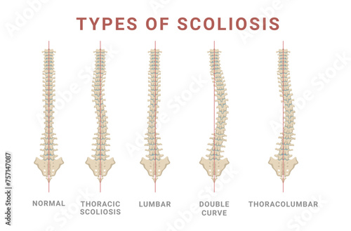Scoliosis types spine skeleton normal and disease structure with names vector flat illustration photo