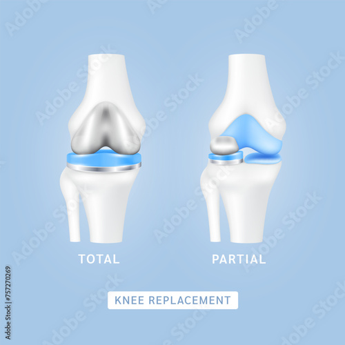 Knee replacement surgery total or partial implant for treatment relieve arthritis, after joint damaged. Leg bone and cartilage. Innovation medical technology treatment. Vector EPS10.