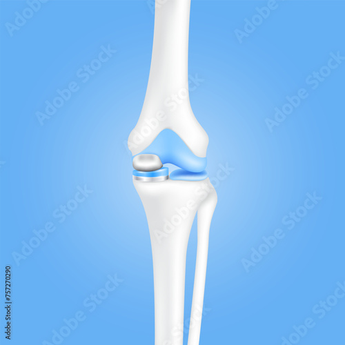 Innovation medical technology treatment. Knee replacement surgery partial or implant for treatment relieve arthritis, after joint damaged. Leg bone and cartilage. 3D realistic vector EPS10.