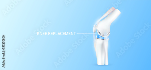 Total knee replacement or implant for treatment relieve arthritis, after joint damaged. Leg bone and cartilage ligaments side. Medical health care science technology concept. 3D vector.