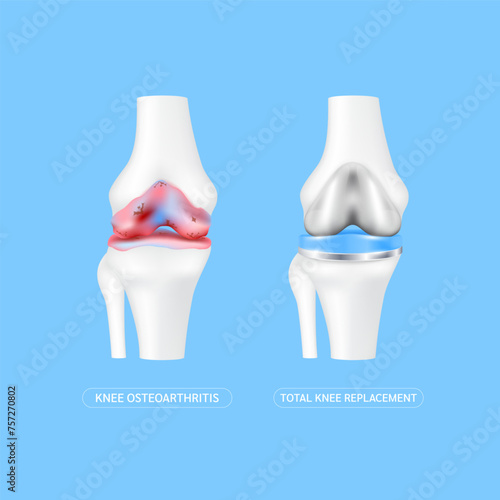 Leg bone osteoarthritis or cartilage severe arthritis knee and Total knee replacement implant. Treatment relieve after joint damaged. Medical health care science technology concept. 3D Vector.