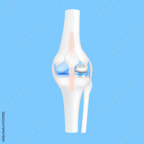 Partial knee replacement surgery or implant for treatment relieve arthritis, after joint damaged. Leg bone and cartilage ligament. Innovation medical technology treatment. 3D realistic vector EPS10.