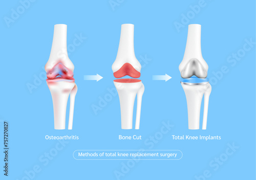 Methods of total knee replacement surgery or implant. Osteoporosis or severe arthritis joint. Leg bone cartilage. Innovation medical technology treatment. Vector.