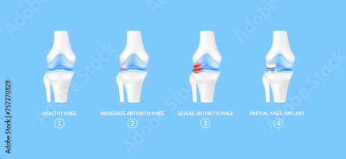 Stage of partial knee replacement or implant. Healthy leg bone cartilage, moderate severe arthritis knee. Treatment relieve after joint damaged. Medical health care science technology concept. Vector.