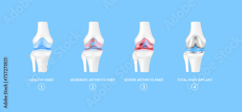 Stage of total knee replacement or implant. Healthy leg bone cartilage, moderate severe arthritis knee. Treatment relieve after joint damaged. Medical health care science technology concept. Vector.