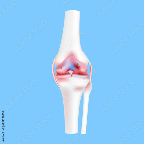 Leg bone cartilage and ligament damaged osteoarthritis or severe arthritis knee joint. Medical science concept. 3D realistic vector EPS10.