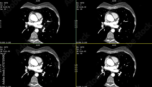 Tableau sur toile Axial contrast of the cardio system with radiology