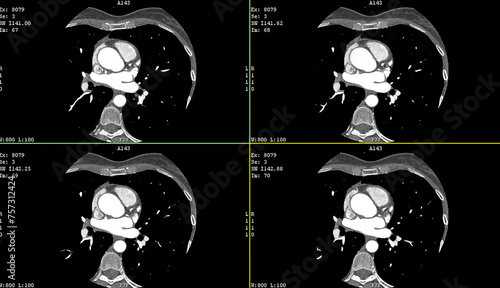Tableau sur toile A computerized tomography CT coronary angiogram