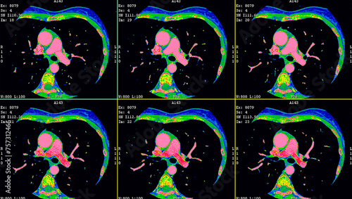 Coronary CT angio or 3d cardiac CTA
