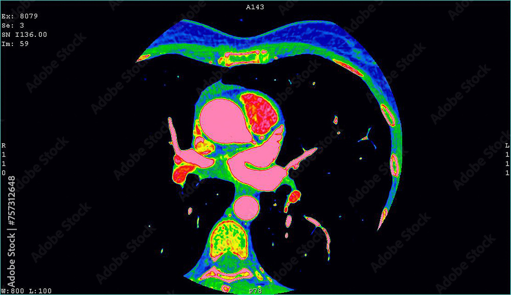 Axial images showing a thymic carcinoma CT cardiac scan. Computer