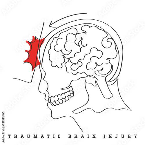 Hand drawn line art depicting Brain Injury. Traumatic Brain Injury Awareness flashcard. Concussion and Brain structure damage.