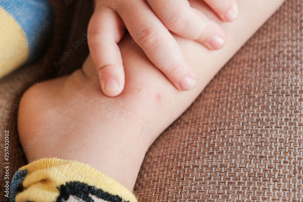 Mosquito bites sore on toddlers legs, many wounds and scars on legs of little boy sitting on bed